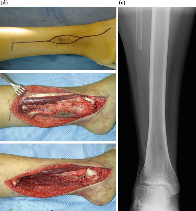 Intraop ewing-sarkom 2