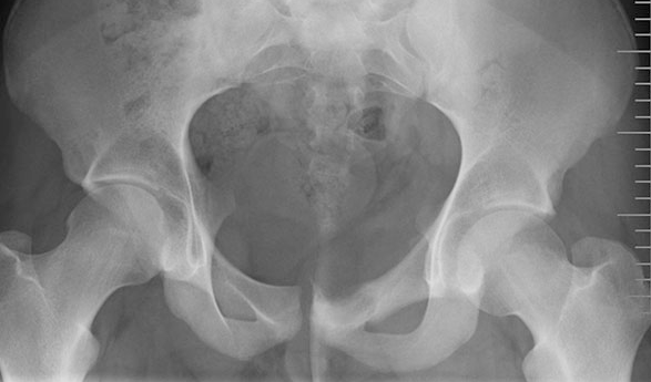 Frontal Bäcken