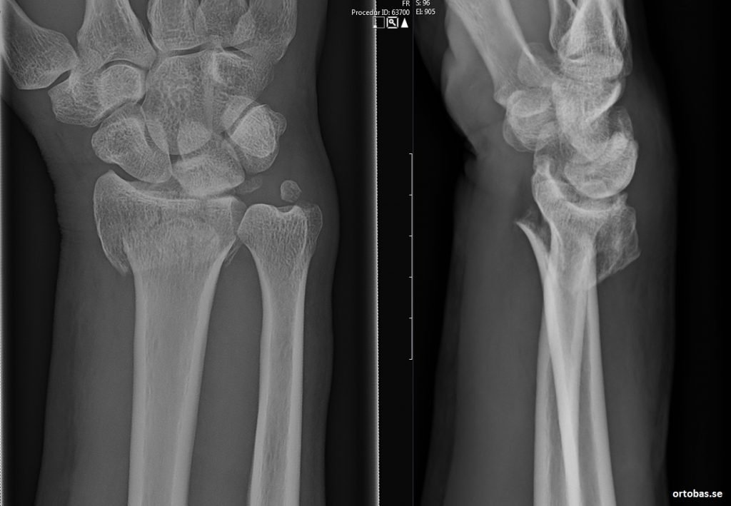 distal radiusfraktur
