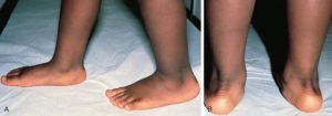 pes planus